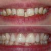 Восстановление зубов любой сложности цифровыми коронками за ОДНО посещение