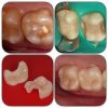 Восстановление зубов любой сложности цифровыми коронками за ОДНО посещение